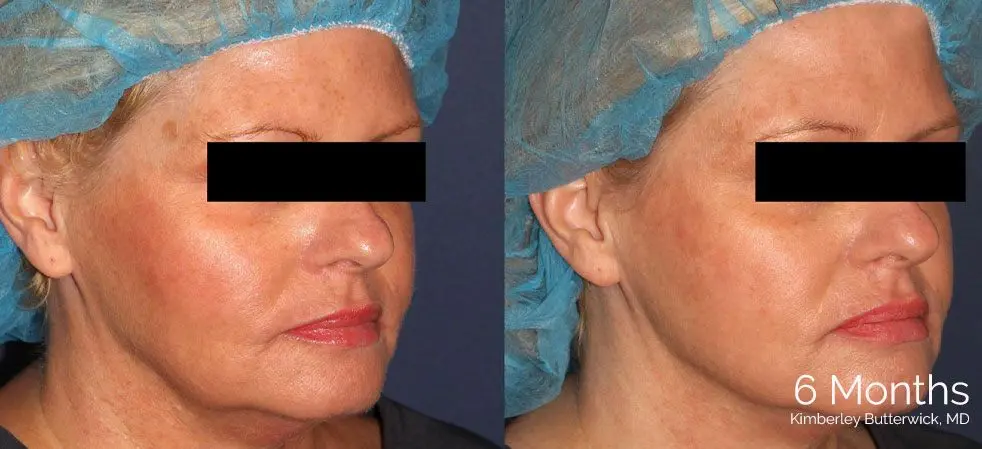 instalift before and after