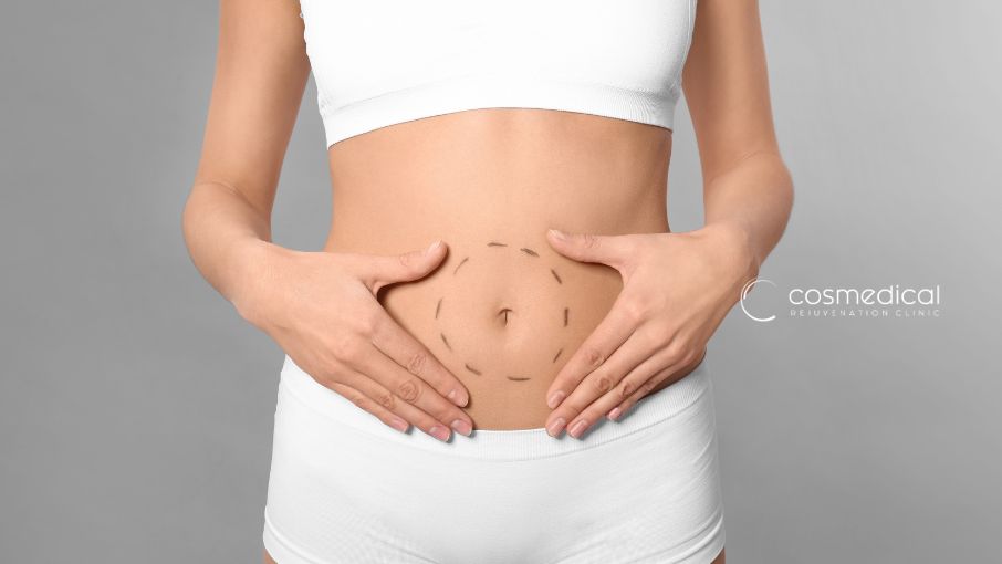 woman showing stomach after tummy tuck