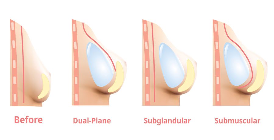 placement of breast implants