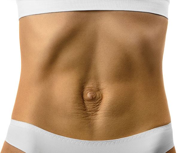 diastasis recti