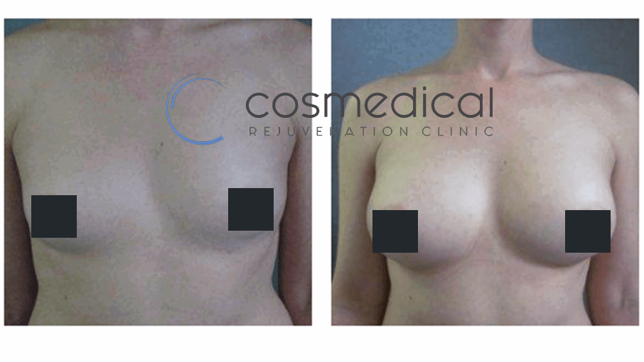 fat transfer breast augmentation before after