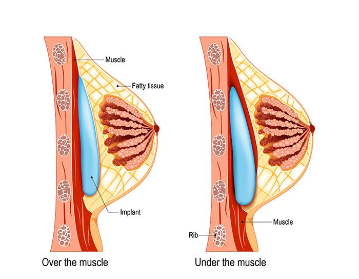 breast implant placement