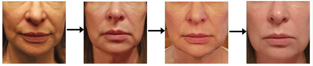 instalift before after