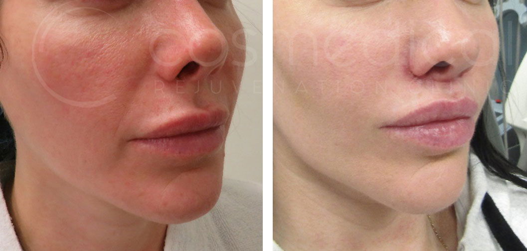 lip lift before and after 