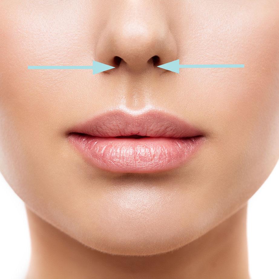 lip lift incision location