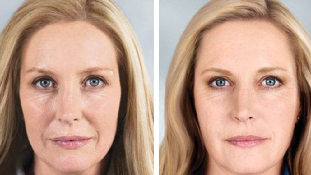 before and after sculptra