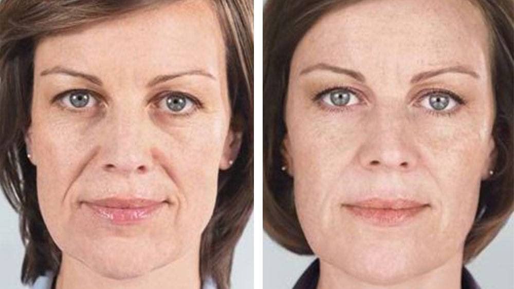 before and after sculptra