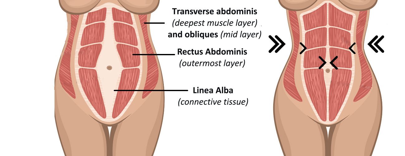 tummy tuck diagram