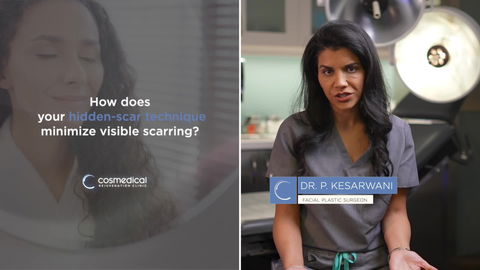 Facelift Patient Results - Patient 4