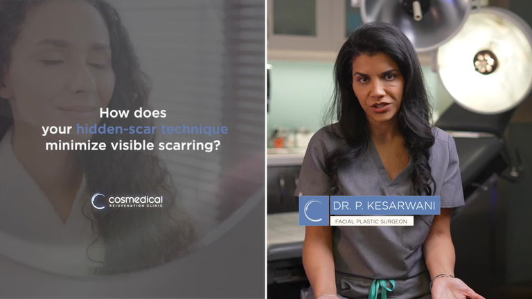 Facelift Patient Results - Patient 4