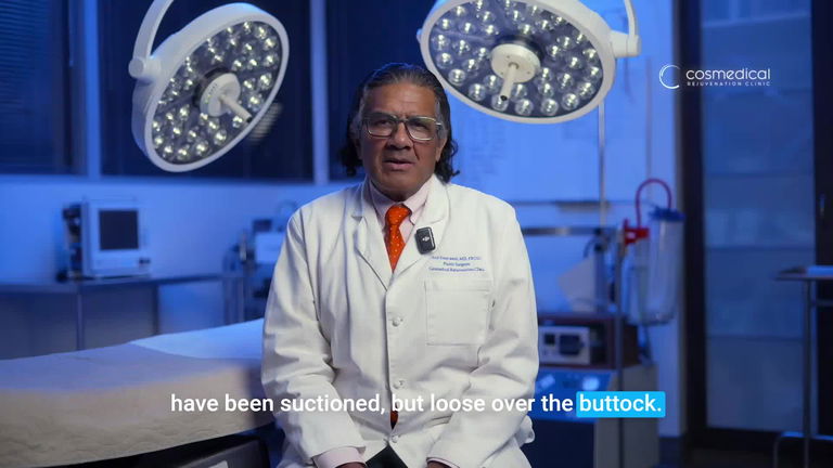 Brazilian Butt Lift Before and After - Patient 3